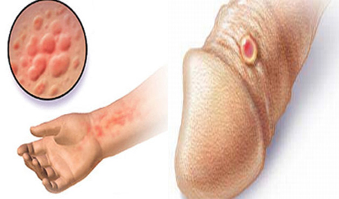 Obat Sipilis Di Puskesmas