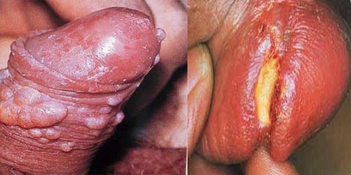 Obat Sipilis Di Jual Di Apotik