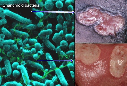 cara pengobatan sipilis dengan bawang putih